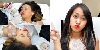 Transformasi Felly Chibi Before & After Sulam Bibir, Cantik Abis!