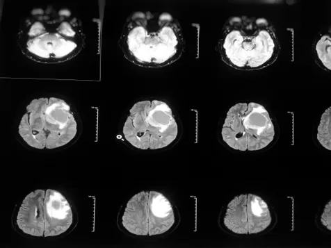 Tanda-tanda Glioblastoma