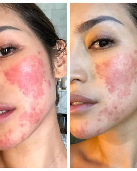 Krim Anastesi Buat Iritasi