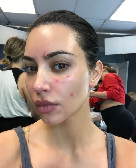 Penuh Psoriasis