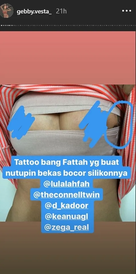 Silikon Payudara yang Bocor Ditutupi Tato