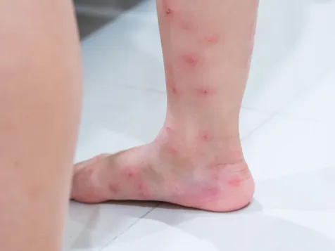 Bukan Penyebab Herpes