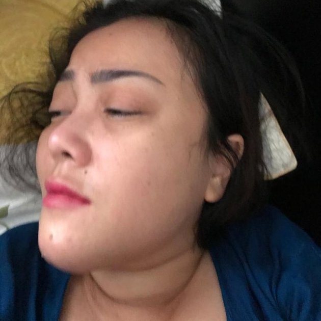 5 Potret Rency Milano who Experienced Medical Malpractice at a Health Clinic, Chin Releasing Pus
