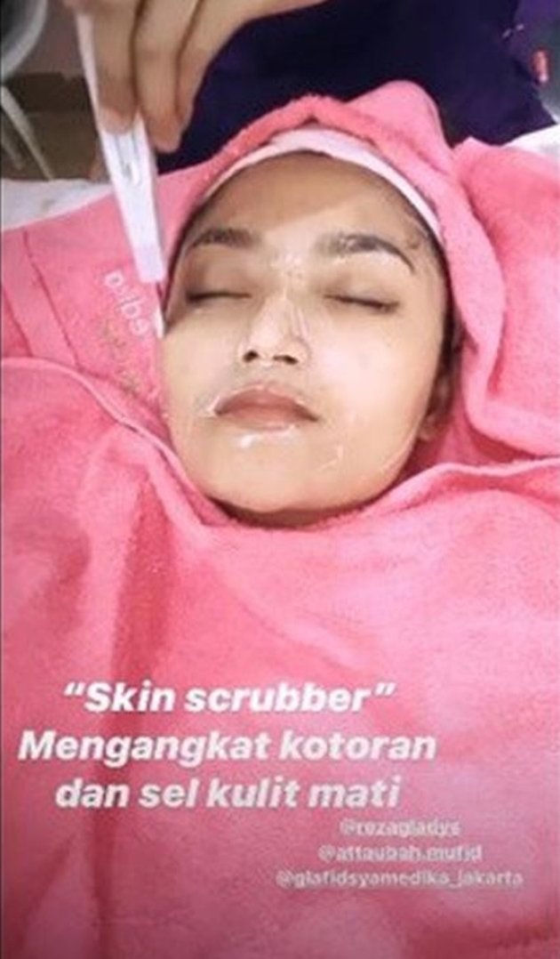 6 Potret Siti Badriah Pasca Filler Bibir, Seksi & Tebal Ala-Ala Kylie Jenner  - KapanLagi.com