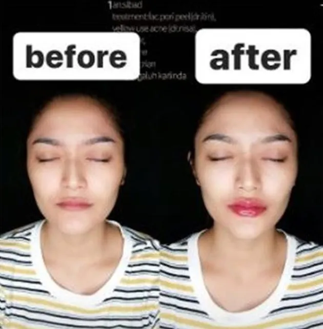 siti badriah, siti badriah filler bibir, pernikahan sitri badriah