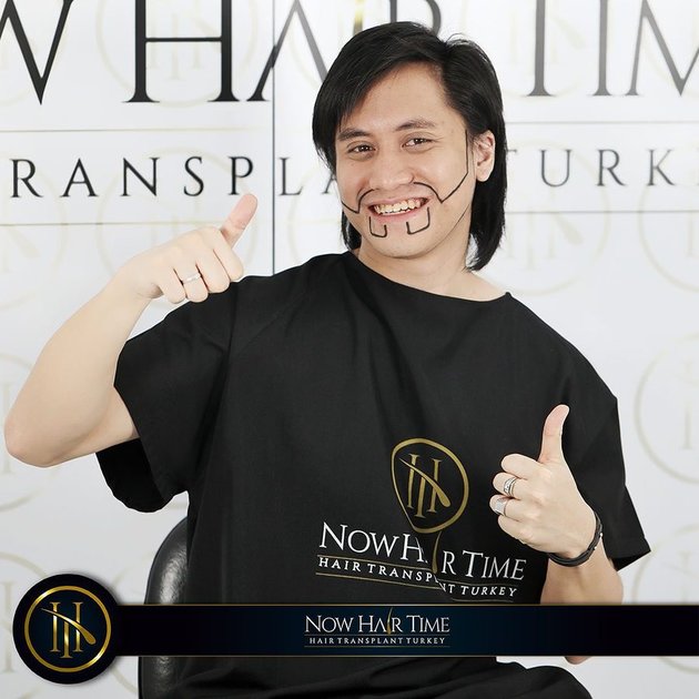 7 Moments Kevin Aprilio Hair Transplant, Lack of Confidence Because of Wide Forehead