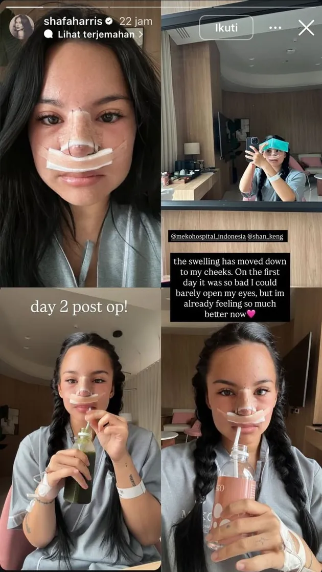 Potret Shafa Harris usai oplas hidung