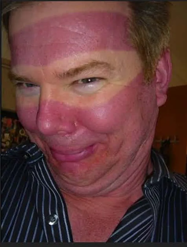 sunburn, bekas matahari, kelamaan berjemur, luka bakar kulit