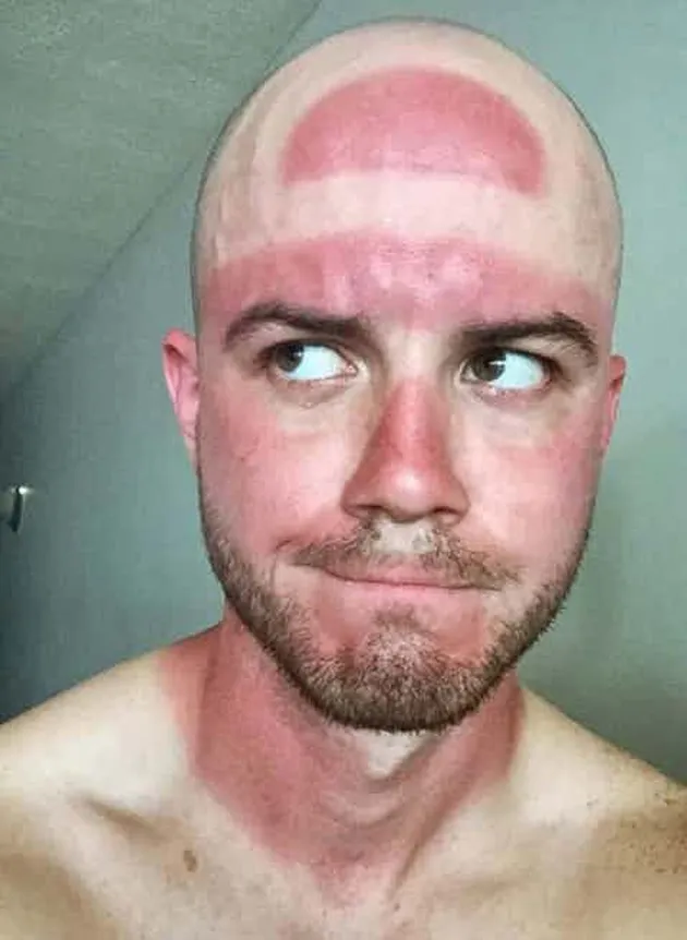 sunburn, bekas matahari, kelamaan berjemur, luka bakar kulit
