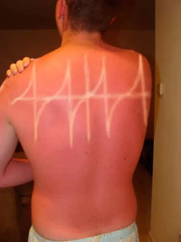 sunburn, bekas matahari, kelamaan berjemur, luka bakar kulit