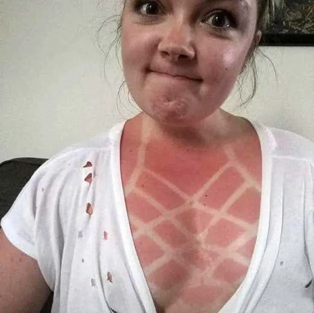 sunburn, bekas matahari, kelamaan berjemur, luka bakar kulit