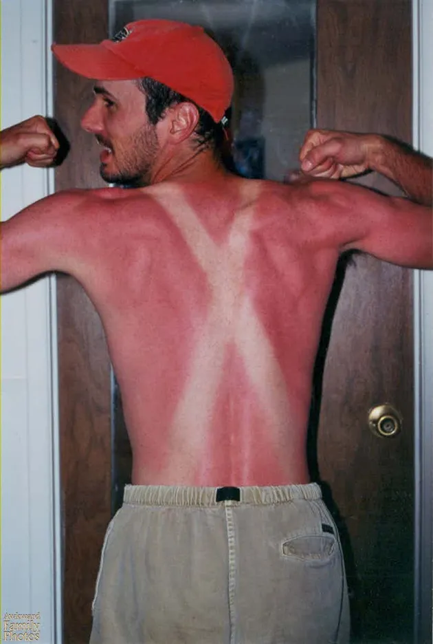 sunburn, bekas matahari, kelamaan berjemur, luka bakar kulit