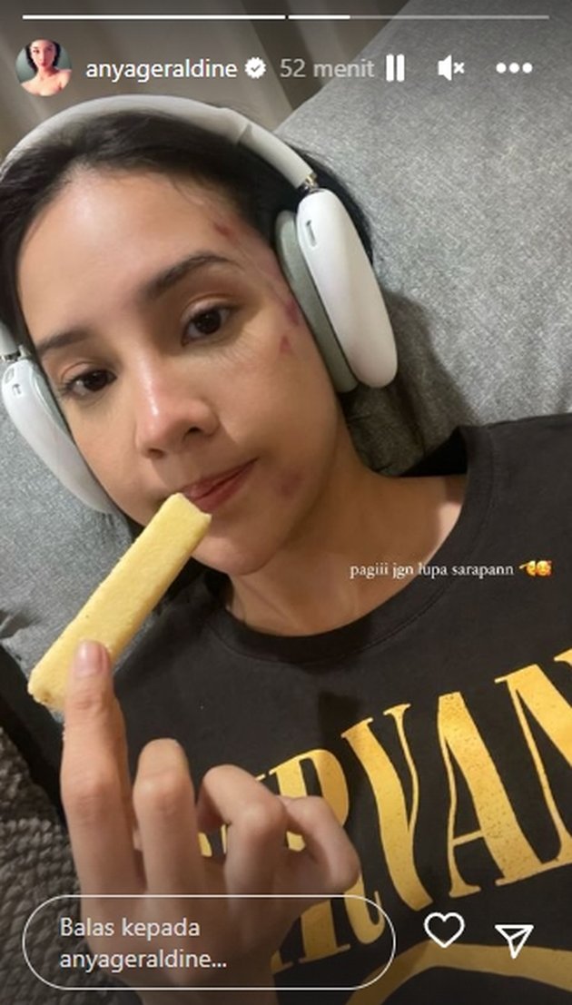 8 Potret Anya Geraldine Hit by Durian Tree, Her Face is Bruised and Swollen - Still Beautiful and Called the Ideal Woman