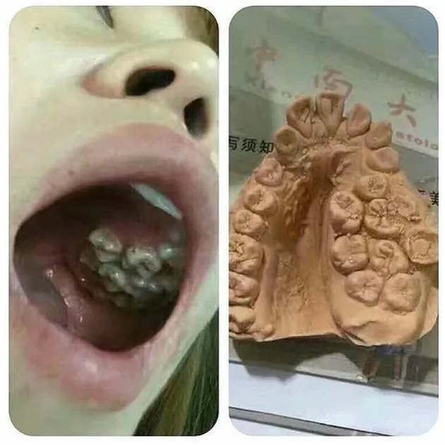hyperdontia, kelainan gigi, kelainan pada gigi