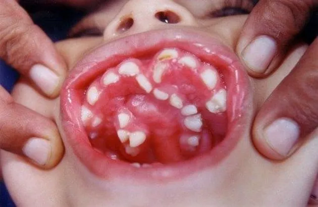 hyperdontia, kelainan gigi, kelainan pada gigi