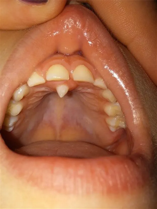 hyperdontia, kelainan gigi, kelainan pada gigi