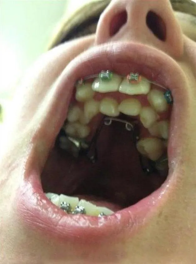 hyperdontia, kelainan gigi, kelainan pada gigi