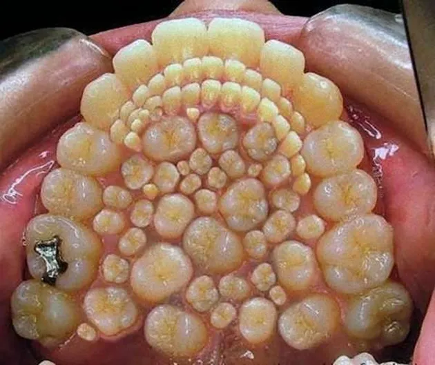hyperdontia, kelainan gigi, kelainan pada gigi