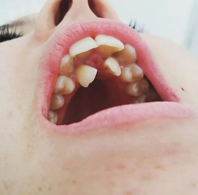 hyperdontia, kelainan gigi, kelainan pada gigi