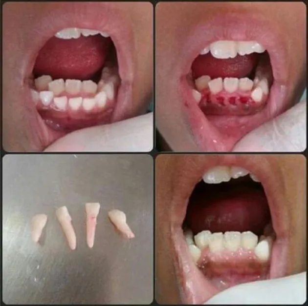 hyperdontia, kelainan gigi, kelainan pada gigi