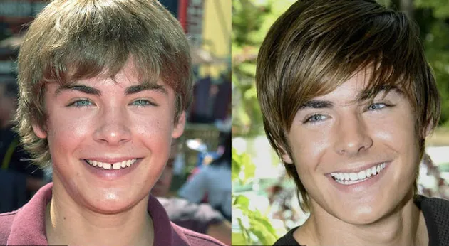 perawatan selebriti, selebriti yang rombak giginya