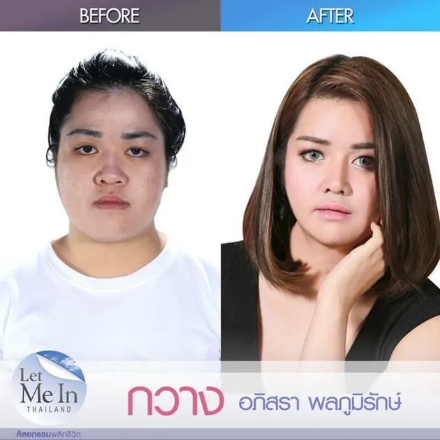 operasi plastik thailand