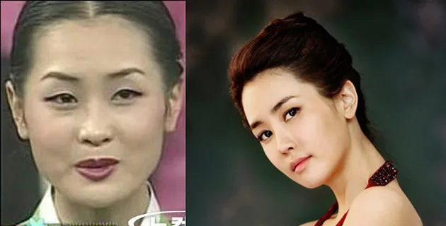 Artis Korea Operasi Plastik