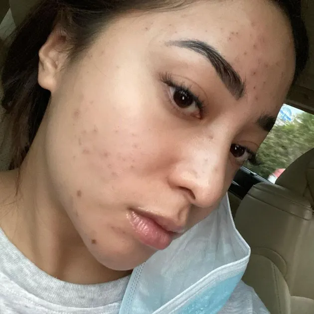 Nikita Willy berjerawat