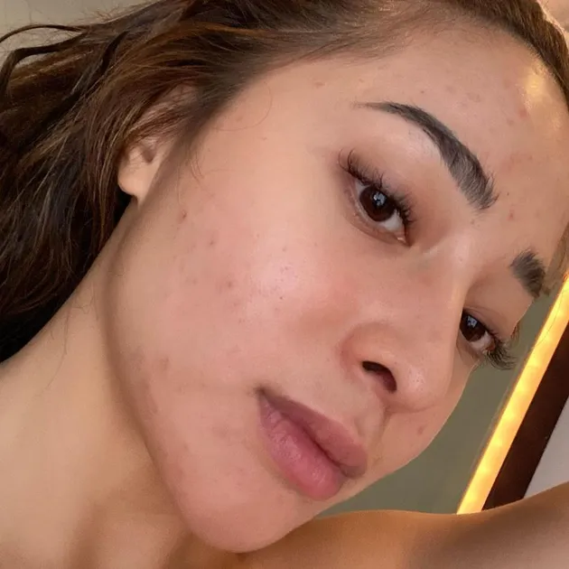 Nikita Willy berjerawat