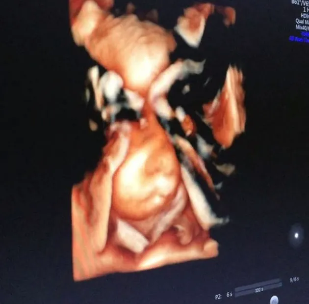 Baby Zhafran, Putra Zumi Zola 