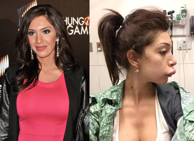 Seleb Yang Lakukan Lip Injections