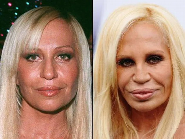 Seleb Yang Lakukan Lip Injections
