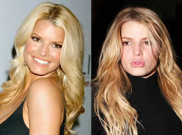 Seleb Yang Lakukan Lip Injections
