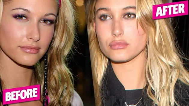 Seleb Yang Lakukan Lip Injections