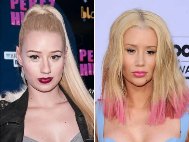 Seleb Yang Lakukan Lip Injections