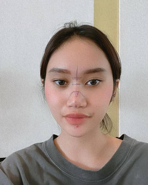 Photo of Dhyaz, Farida Nurhan's Child, After Plastic Surgery, Swollen and Bruised Face Makes Netizens Curious About the Results