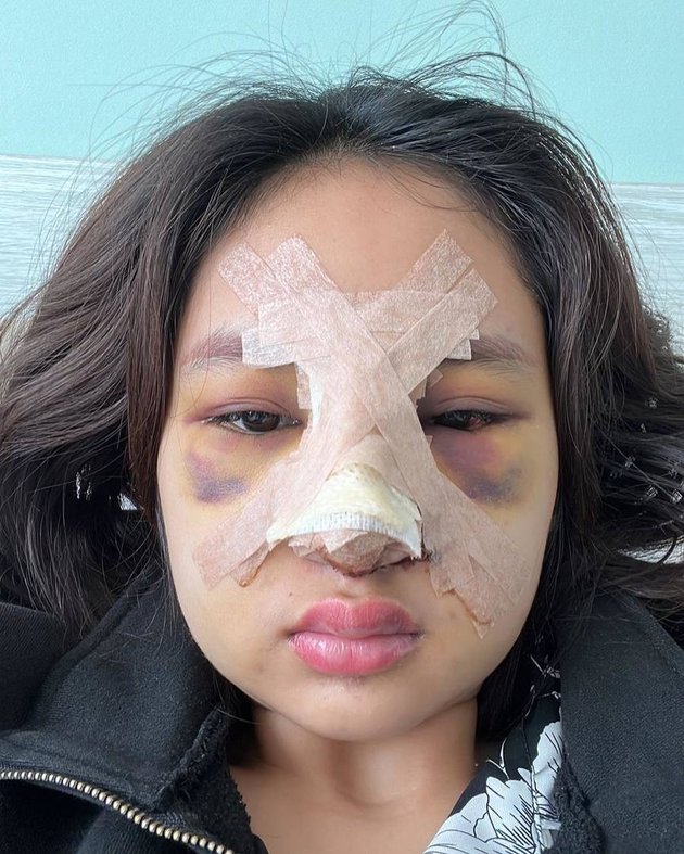 Photo of Dhyaz, Farida Nurhan's Child, After Plastic Surgery, Swollen and Bruised Face Makes Netizens Curious About the Results