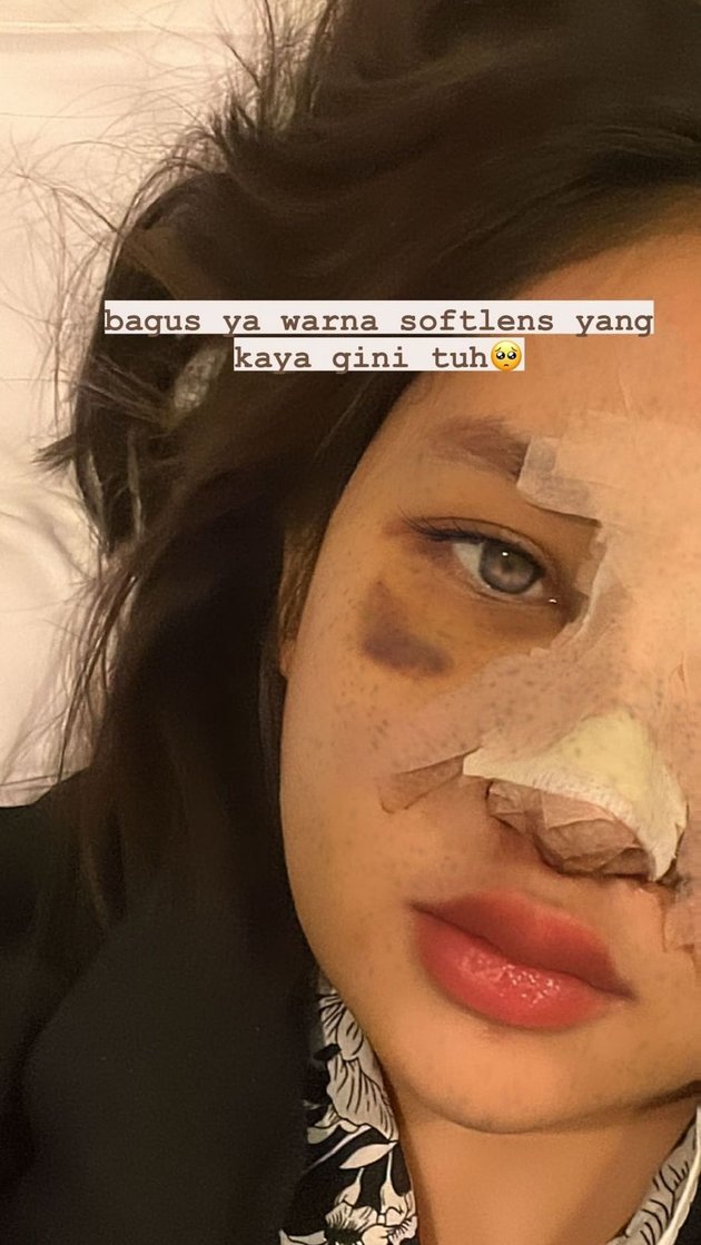 Photo of Dhyaz, Farida Nurhan's Child, After Plastic Surgery, Swollen and Bruised Face Makes Netizens Curious About the Results