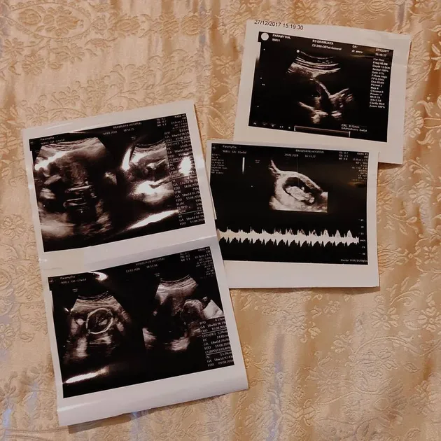 Lewat akun Instagram-nya, Mytha pun memperlihatkan foto hasil USG kandungannya yang sudah berusia 4 bulan atau lebih detailnya lagi, 17 minggu.
