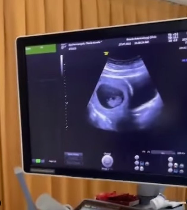 Happy Moments of Aurel Hermansyah's Pregnancy, Atta Halilintar Immediately Takbir Seeing the Results of the Ultrasound
