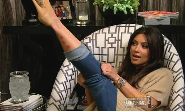 Kim Kardashian Psoriasis