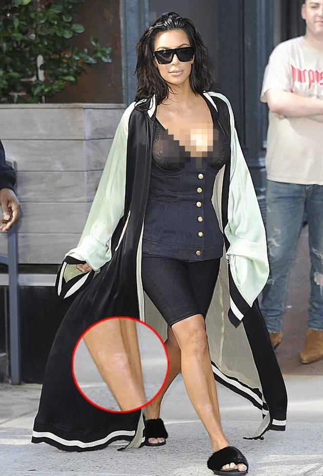 Kim Kardashian Psoriasis