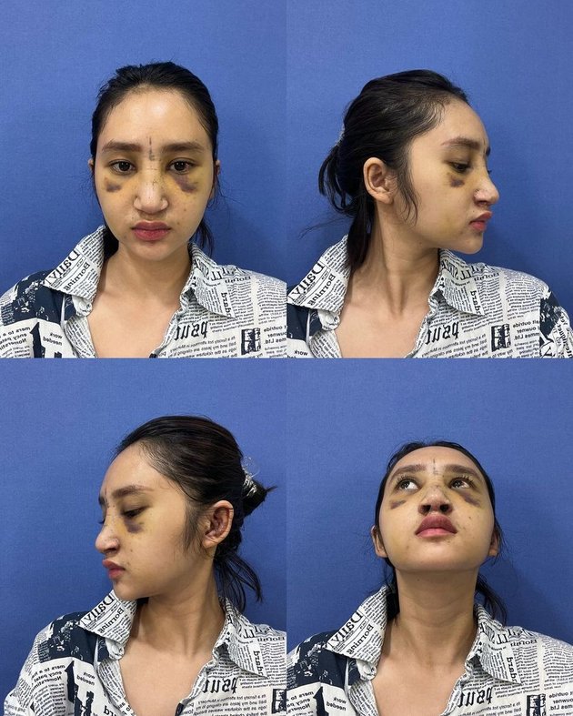 Nose Implant Infection, Portrait of Permesta Dhyaz's Transformation Before and After Plastic Surgery - Face Called Strange by Netizens
