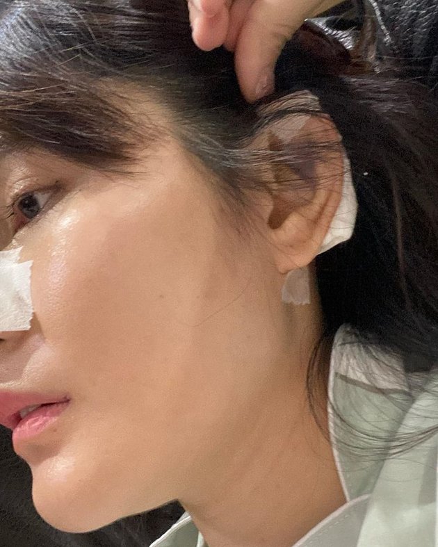 Regret Doing Plastic Surgery, 8 Photos of Angela Lee's Condition After Her New Nose Turns Crooked - Implant Penetrates the Skin