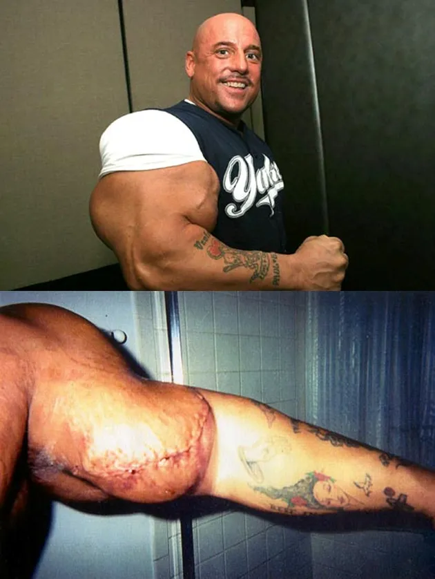 Efek Samping Steroid