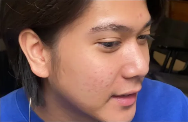 iqbaal dirawat dokter tompi