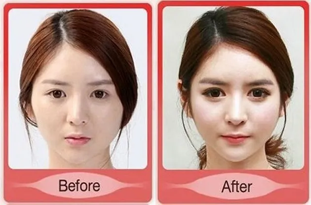 Foto Operasi Plastik Korea