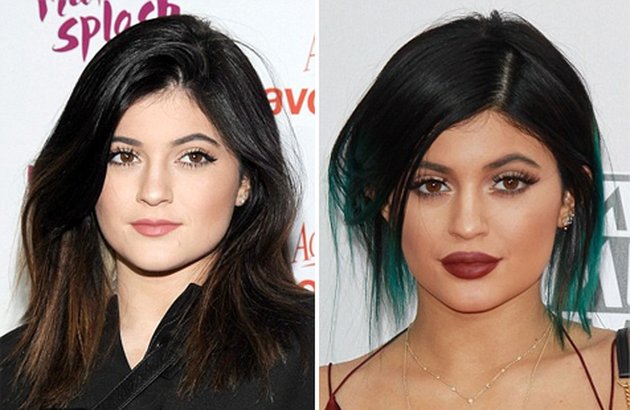 Kylie Jenner, gadis cantik satu ini akhirnya mengakui jika bibir sensualnya merupakan hasil lip injection. Kini, seluruh dunia tahu jika itu bukan hanya tipuan make up.