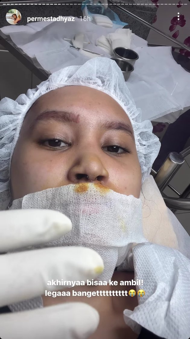 Criticism from Netizens for Swimming After Nose Implant Surgery, 11 Photos of Permesta Dhyaz After Stitches Removed Accompanied by Farida Nurhan