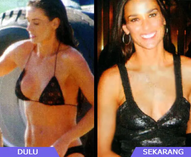 Selebritis dan Operasi Payudara